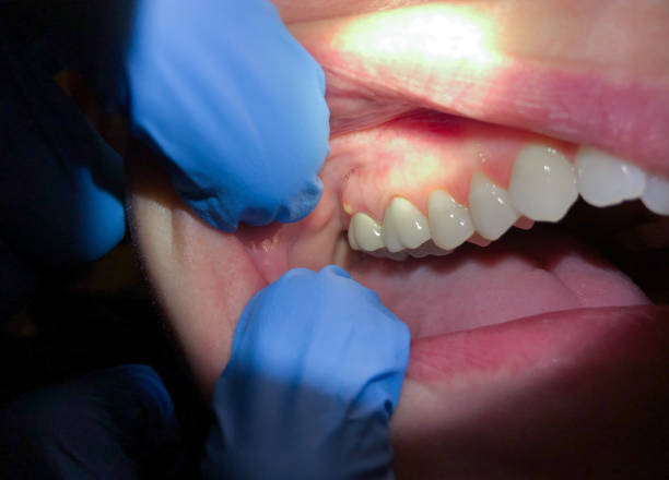 Best Emergency Treatment for Dental Infections or Abscesses in Ojai, CA